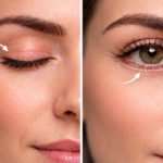 cicatrização blefaroplastia